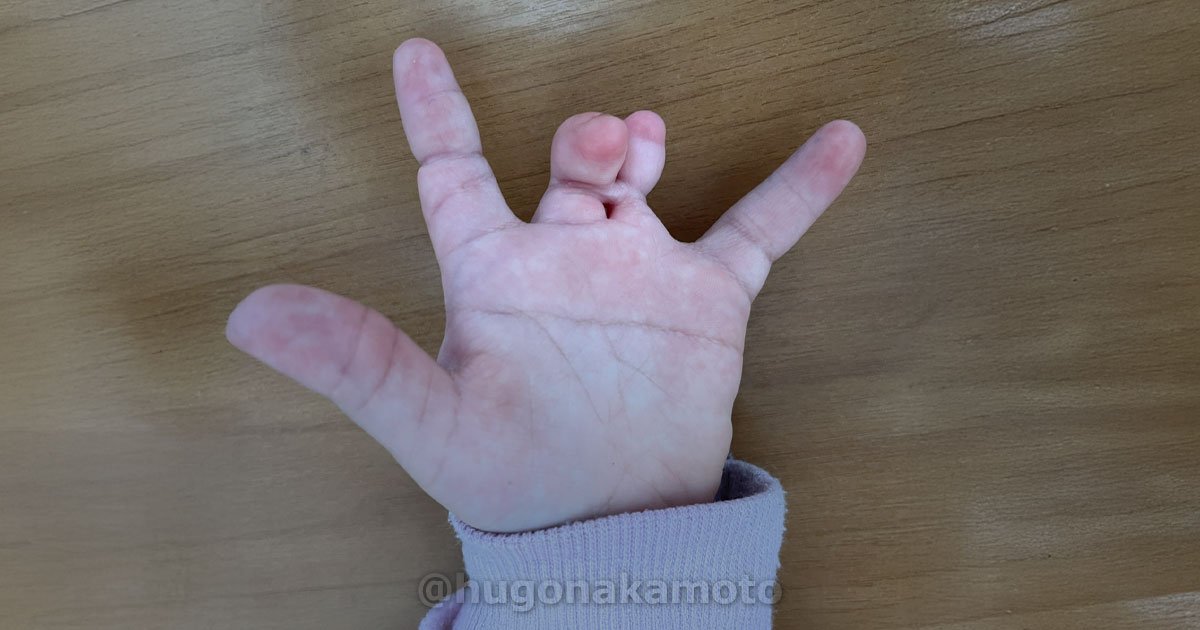 Dr Hugo Nakamoto Cirurgia De Correcao Deformidade Congenita Da Mao Na Av Paulista