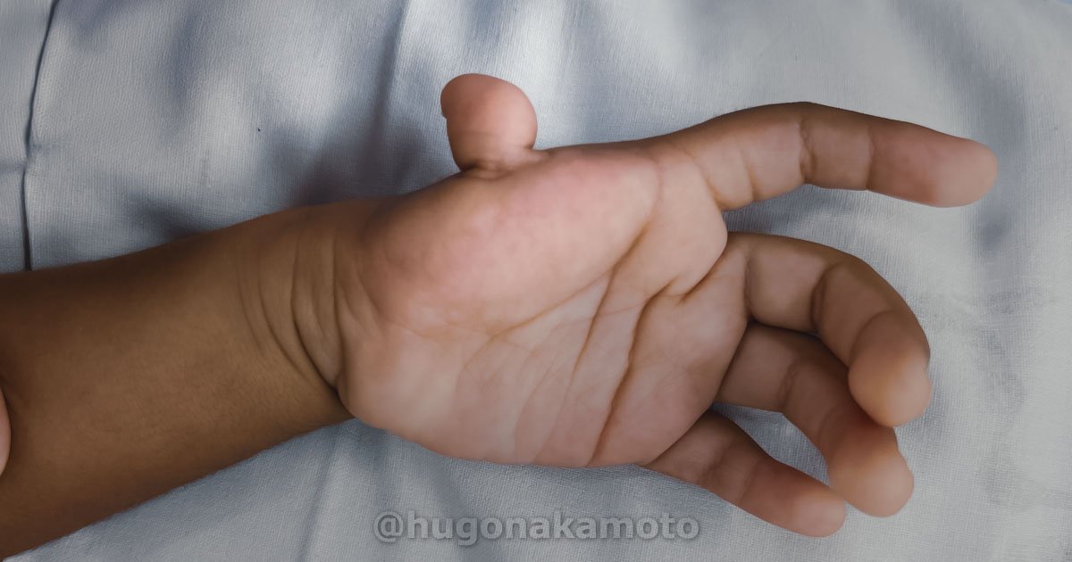 Dr Hugo Nakamoto Cirurgia De Correcao Hipoplasia Polegar Na Av Paulista