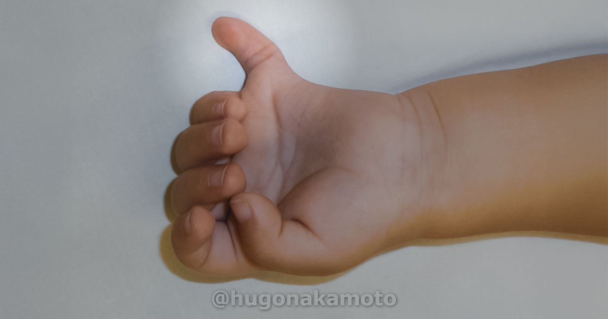 Dr Hugo Nakamoto Cirurgia De Correcao Polidactilia Na Av Paulista