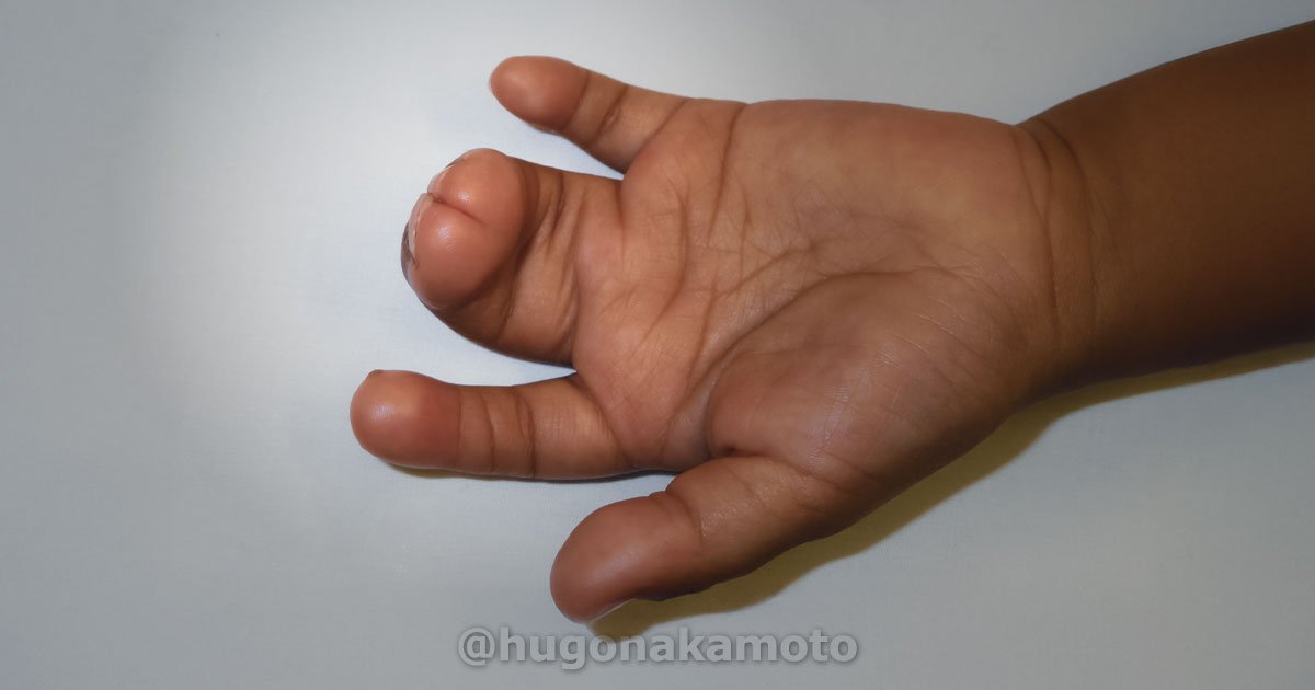 Dr Hugo Nakamoto Cirurgia De Correcao Sindactilia Na Av Paulista