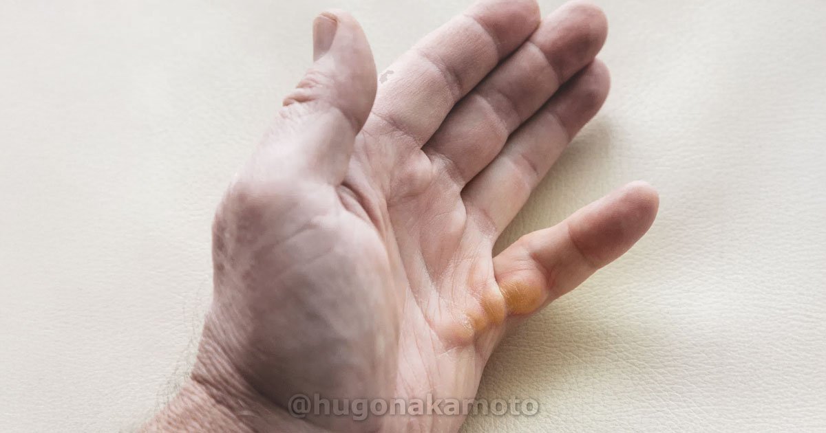 Dr Hugo Nakamoto Especialista Em Molestia De Dupuytren Na Av Paulista