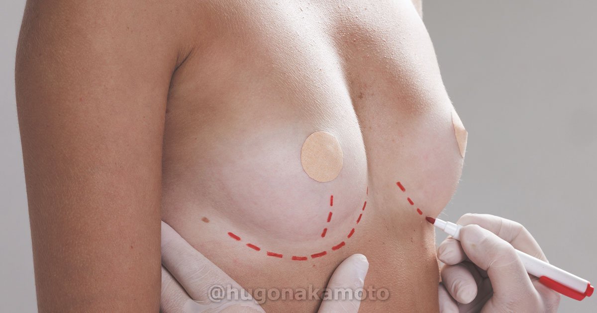 Dr Hugo Nakamoto Especialista Em Plastica Das Mamas Mastoplastia Na Av Paulista