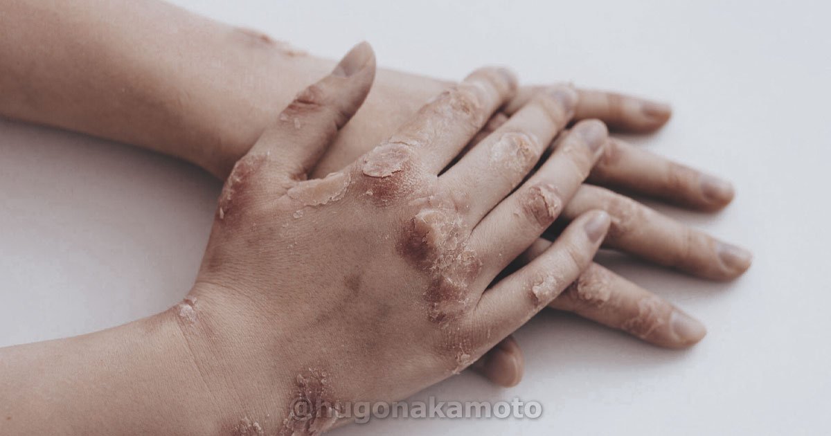 Dr Hugo Nakamoto Especialista Em Queimaduras Na Mao Na Av Paulista