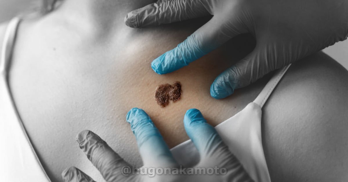 Dr Hugo Nakamoto Especialista Em Retirada De Pintas E Tumores De Pele Na Av Paulista