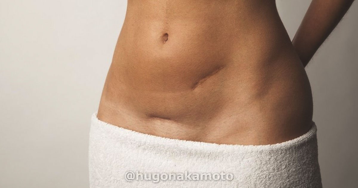 Dr Hugo Nakamoto Especialista Em Tratamento De Cicatrizes Patologicas Na Av Paulista